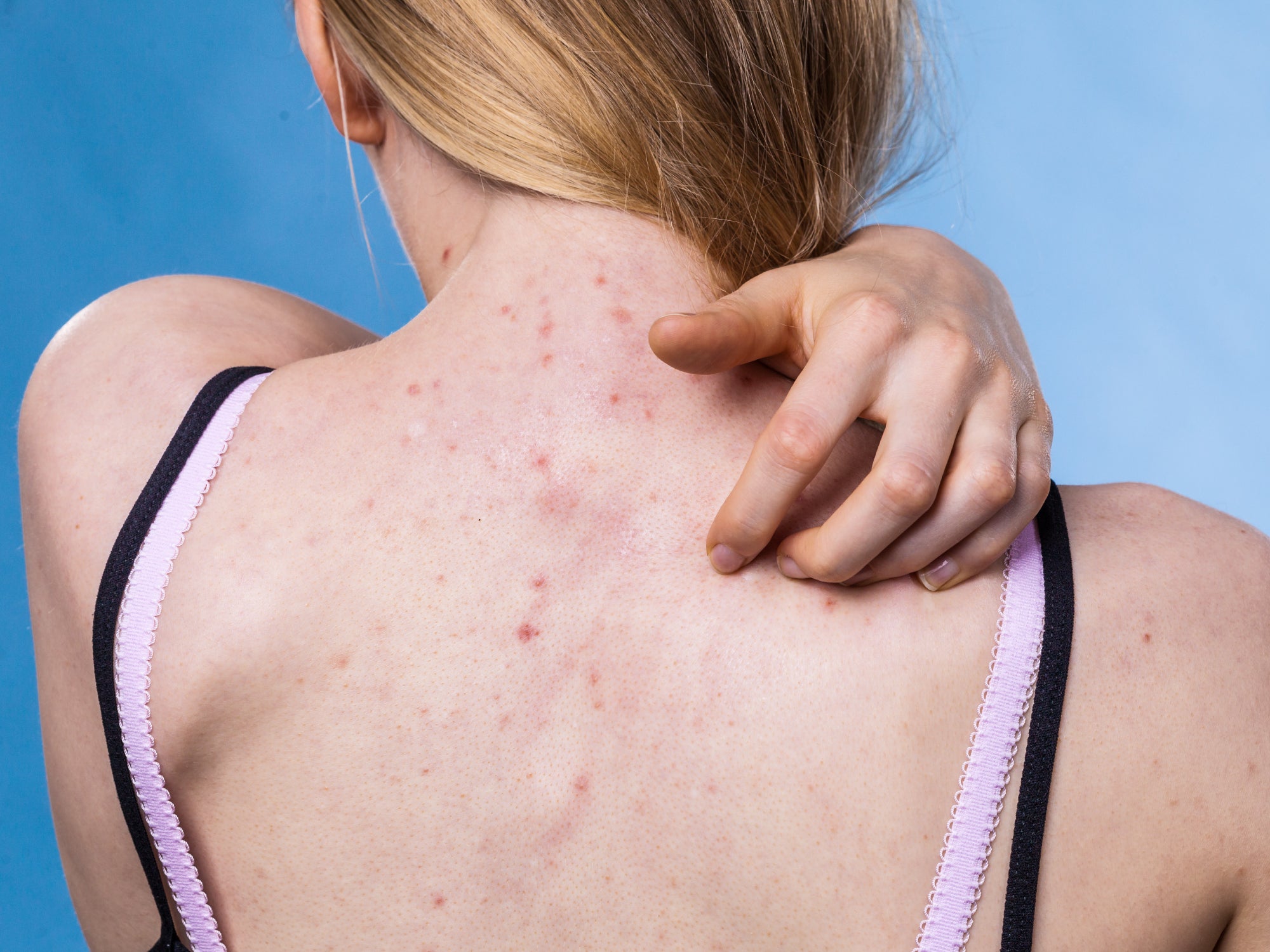7 Reasons You Break Out In Hives