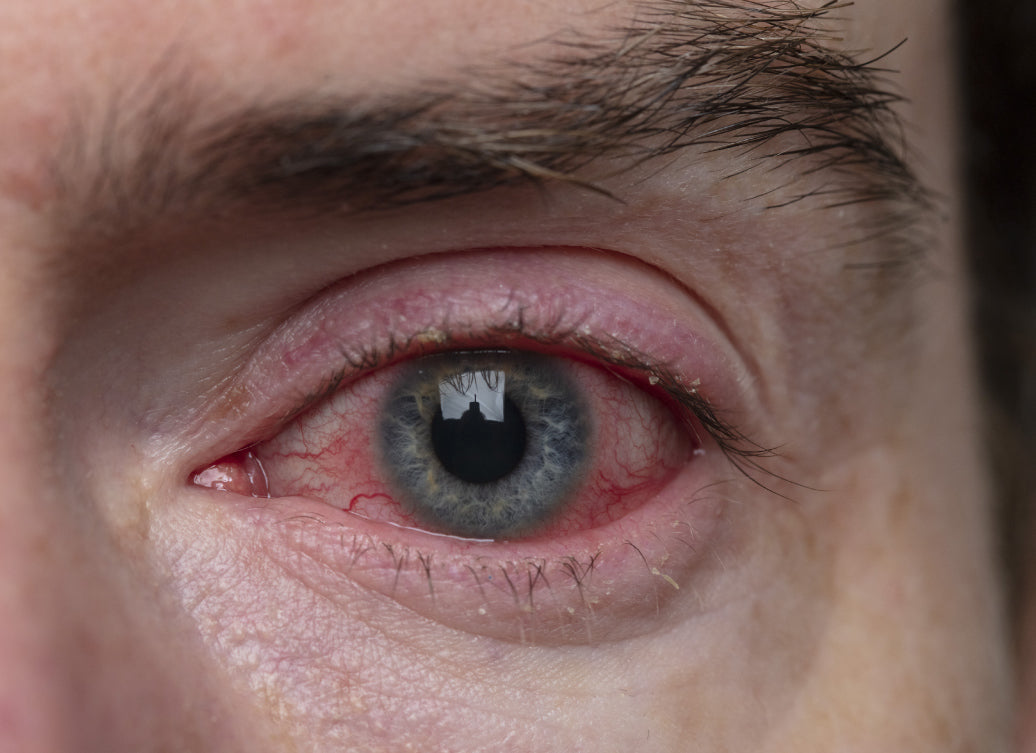An eye showing Blepharitis