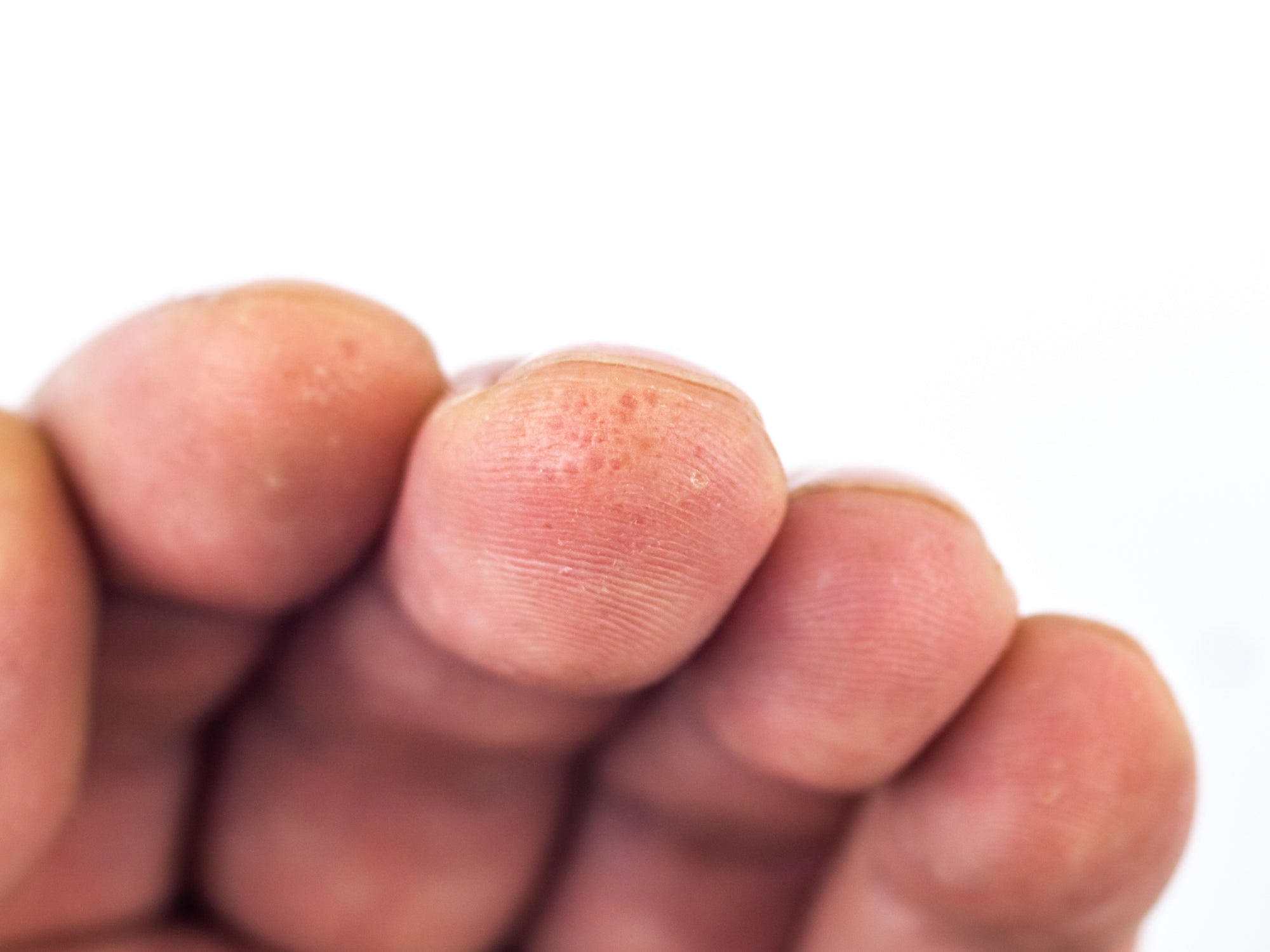 dyshidrotic eczema fingers