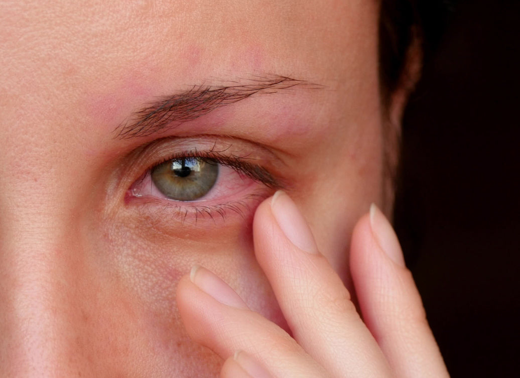 Example of Blepharitis