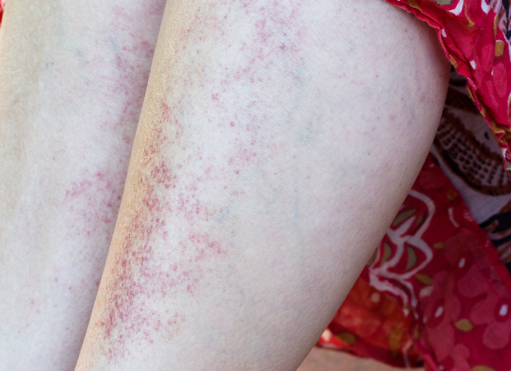 An example of Polymorphic Light Eruption