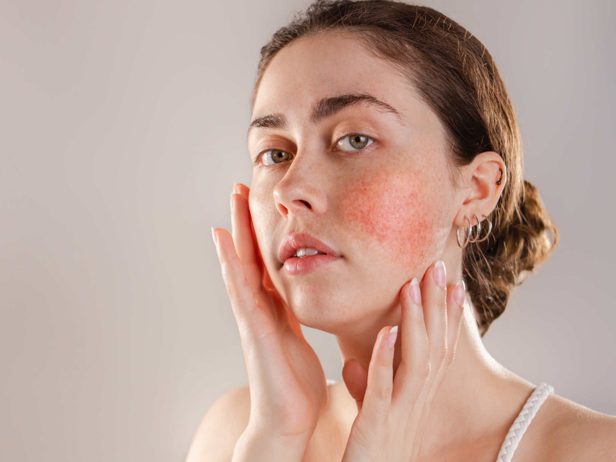 Rosacea Awareness Month Balmonds