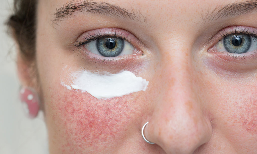 Does Rosacea Ever Go Away?