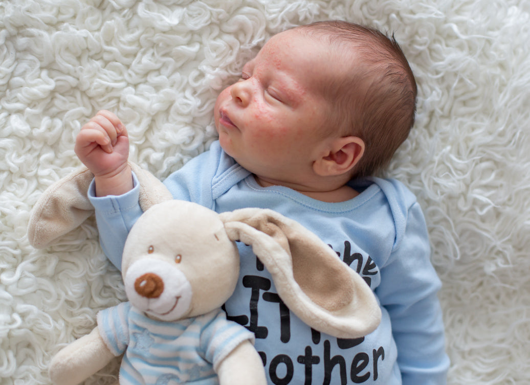 A baby with eczema on cheeks