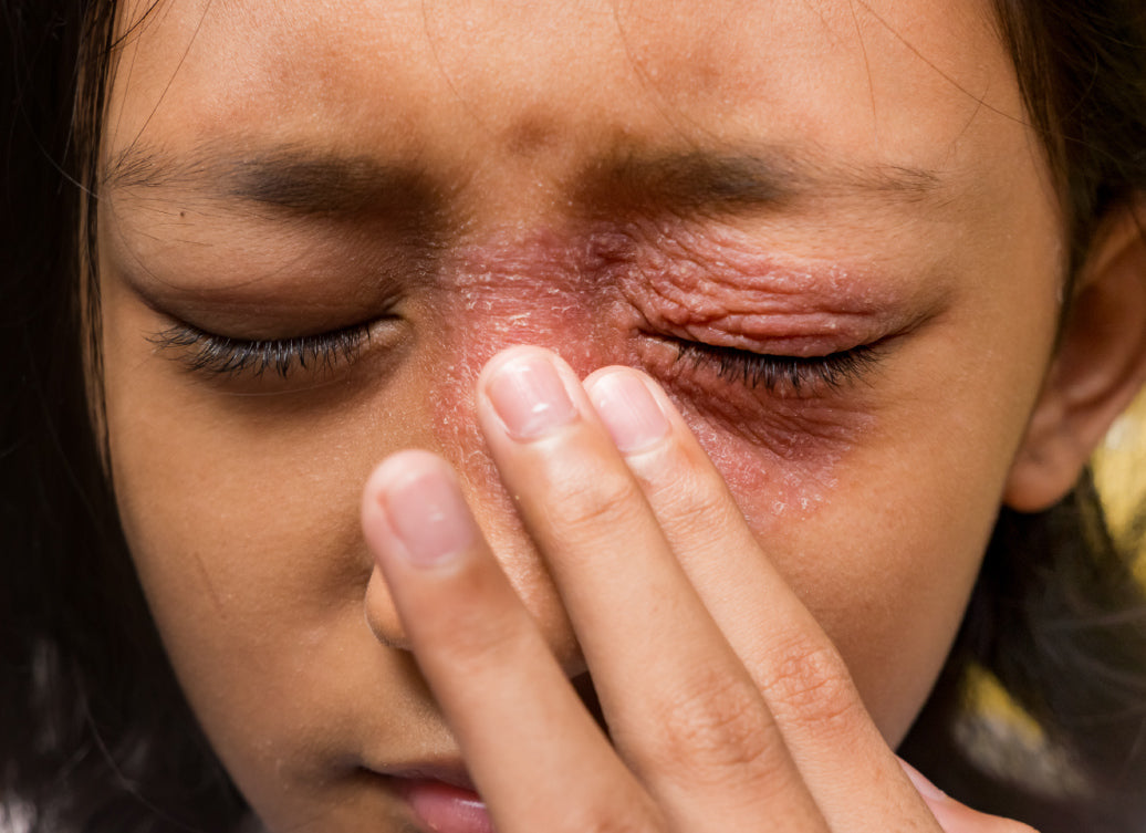 How Do You Treat Periocular Dermatitis?