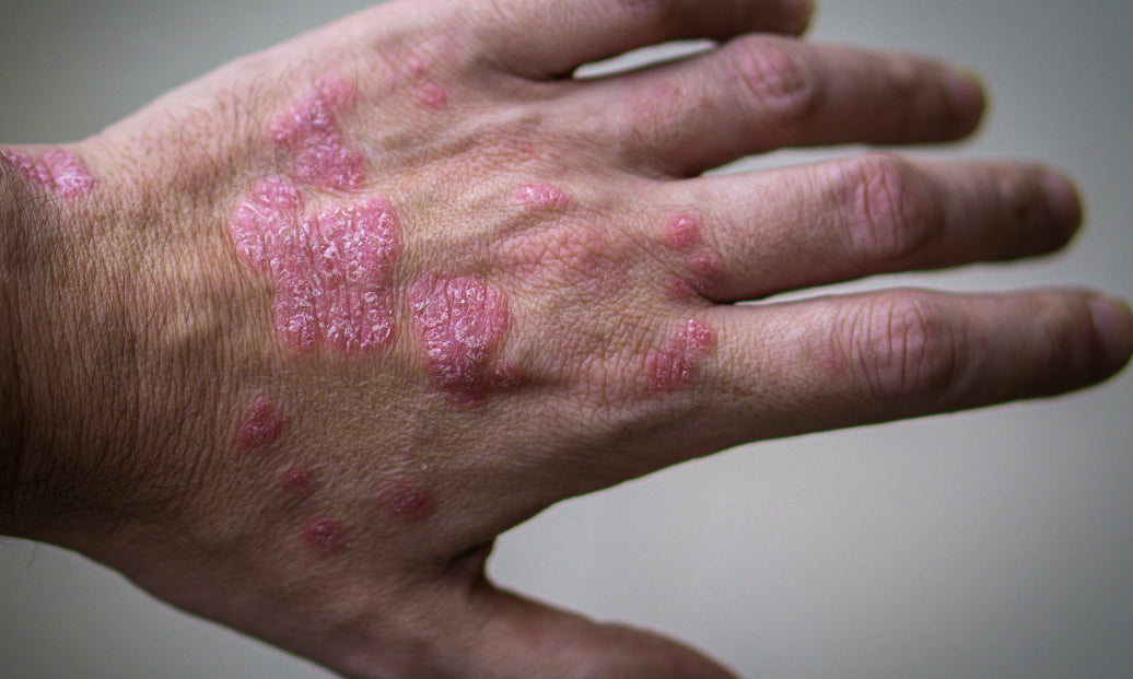 How Serious Is Psoriasis?