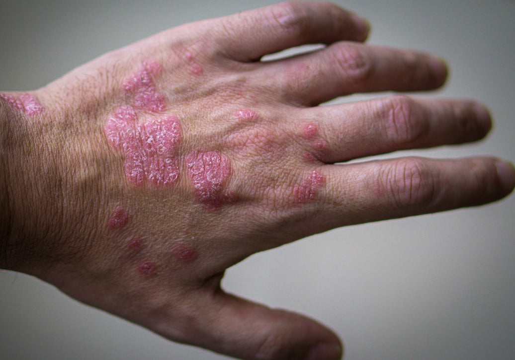 How Serious Is Psoriasis?
