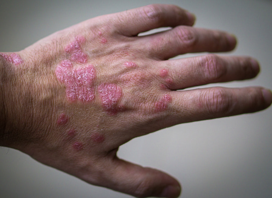 How Serious Is Psoriasis?