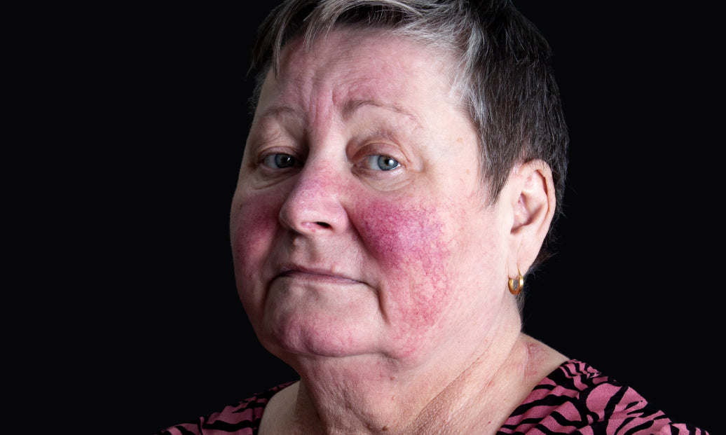 How Serious Is Rosacea?