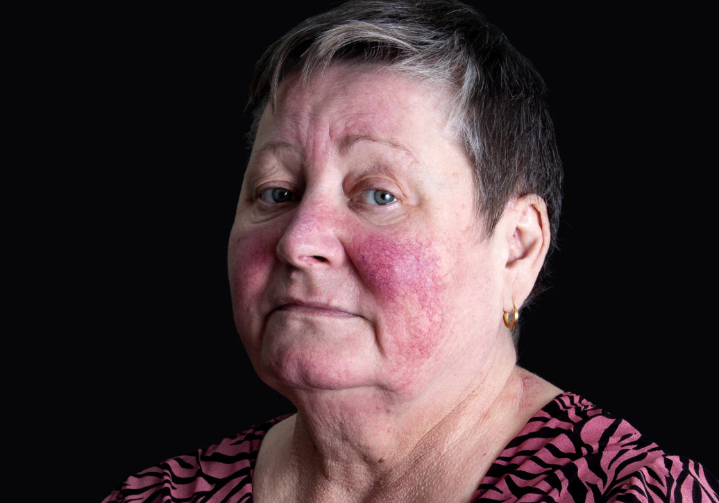 How Serious Is Rosacea?