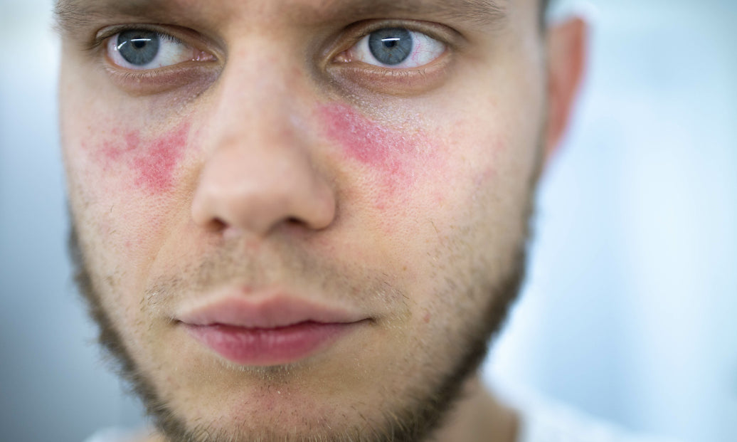 Is Rosacea A Sign Of Lupus?