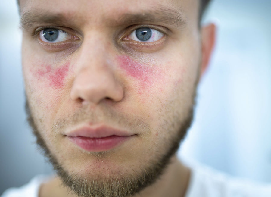 Is Rosacea A Sign Of Lupus?