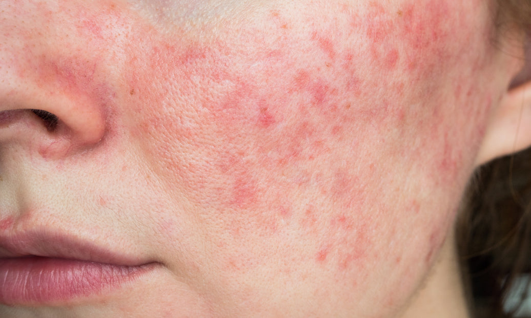 Is Rosacea An Autoimmune Condition?