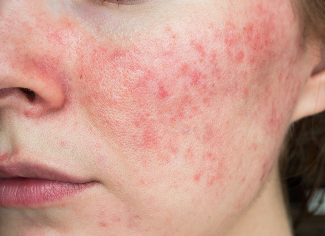 Is Rosacea An Autoimmune Condition?