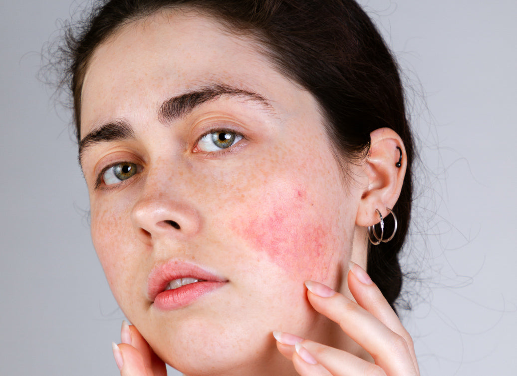 Should I Moisturise Rosacea?