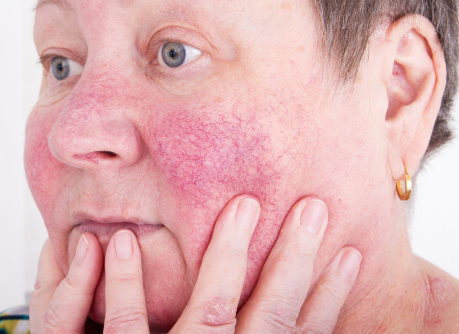 What Causes Rosacea on the Nose?