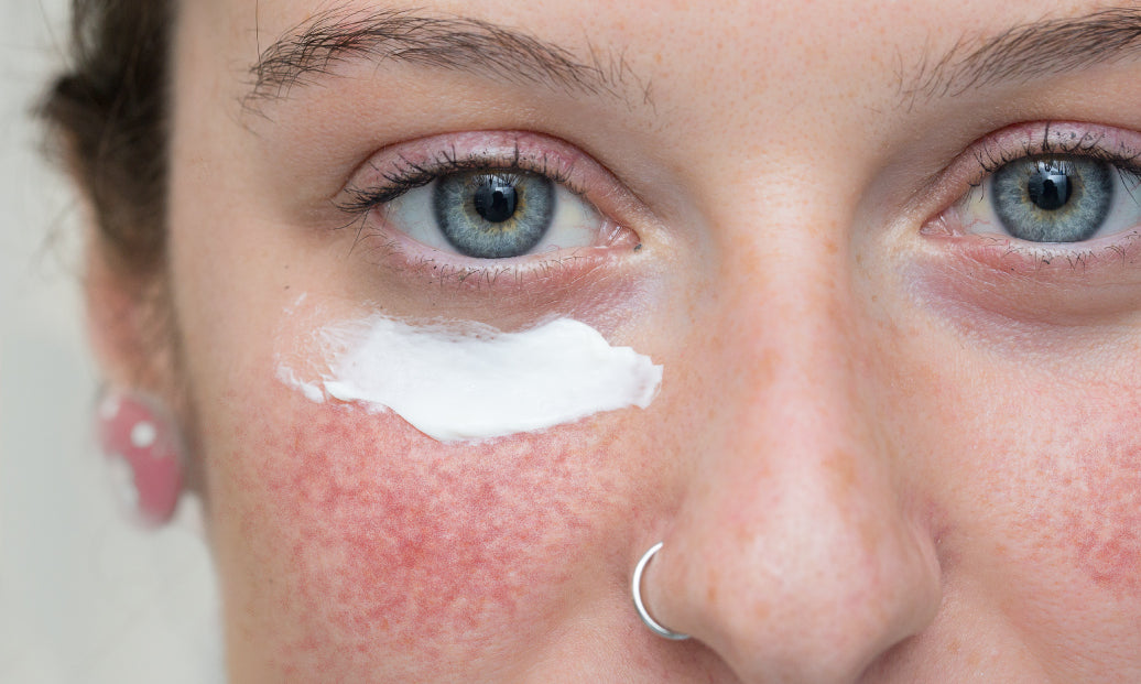 What’s The Best Moisturiser For Rosacea?