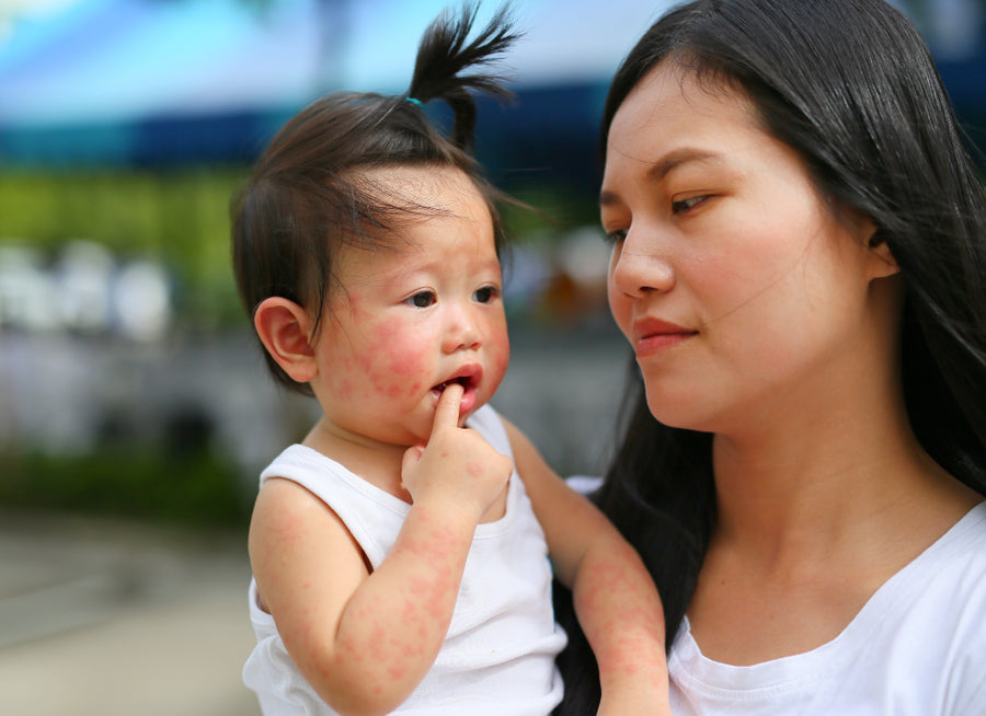 Mother holding child with eczema