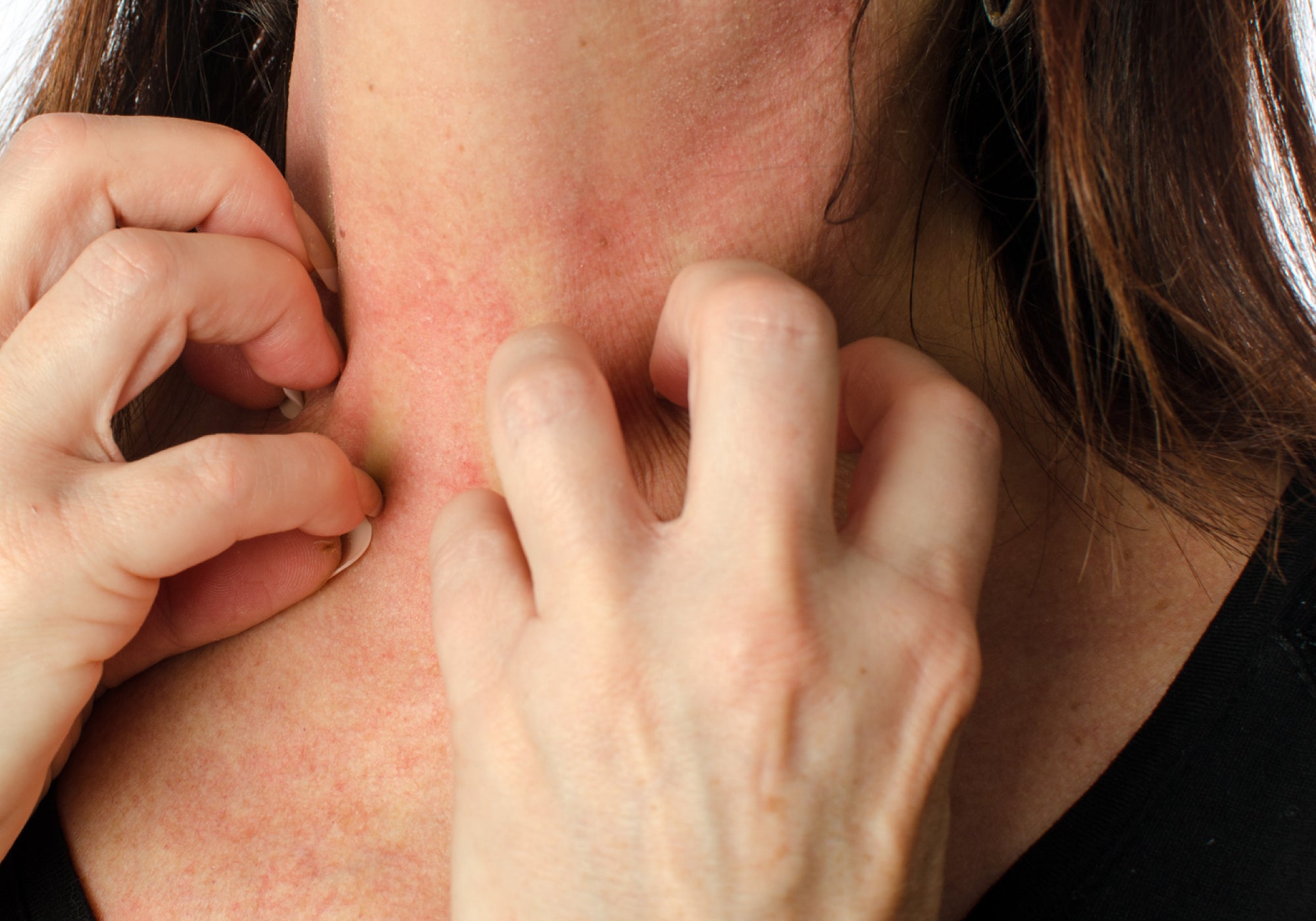 What Does Diabetic Skin Rash Look Like?