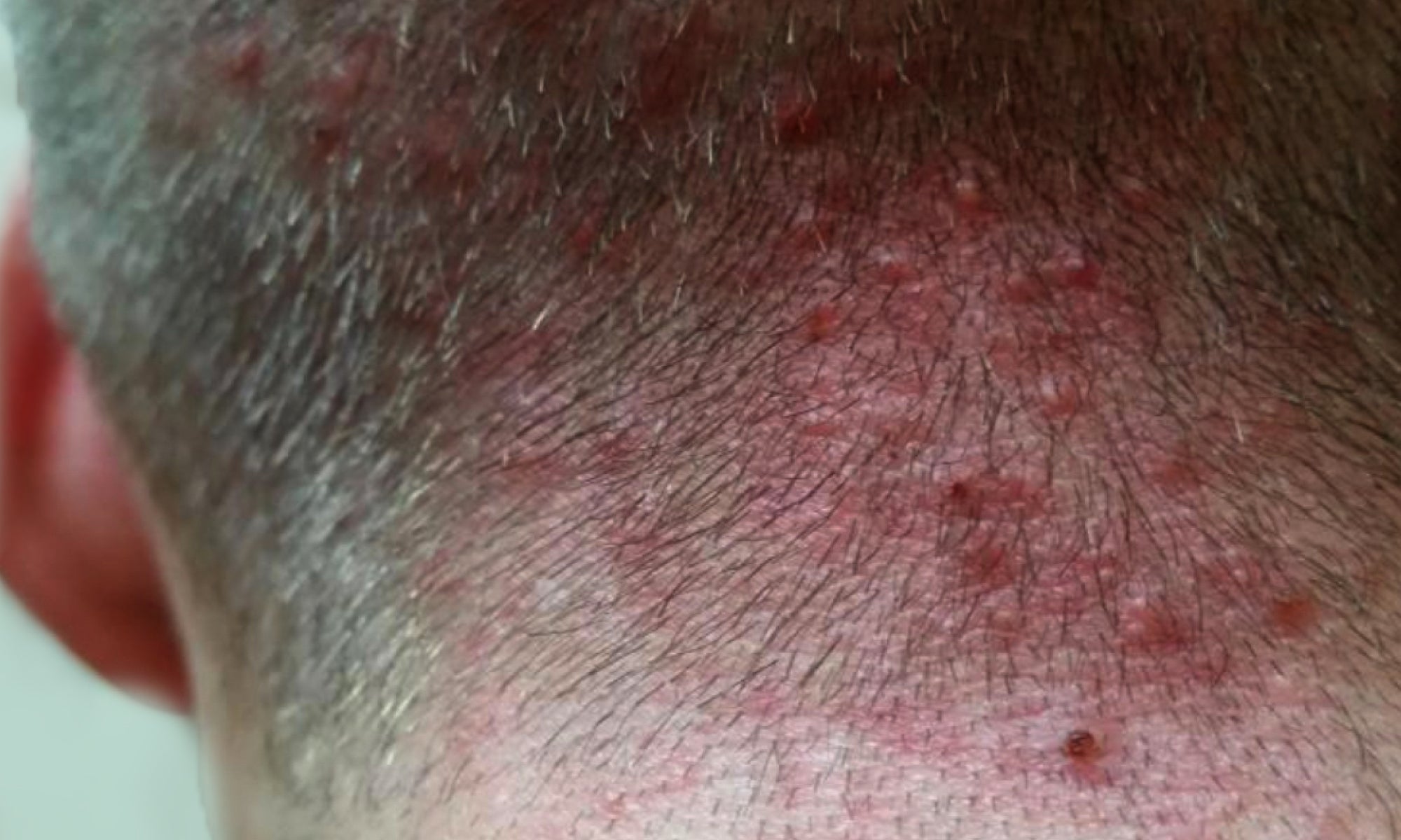 What Does Scalp Folliculitis Look Like?