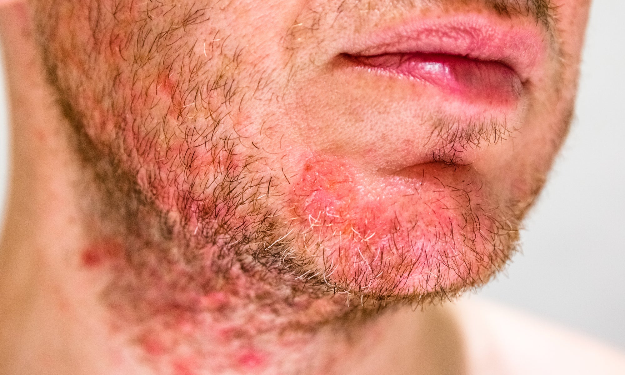 Seborrheic Dermatitis: Causes, Symptoms and Treatment