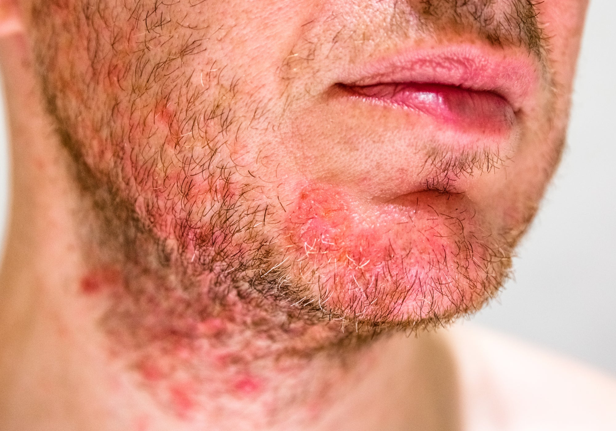 Seborrheic Dermatitis: Causes, Symptoms and Treatment