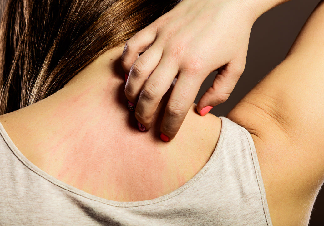 How Do You Treat Chlorine Rash?