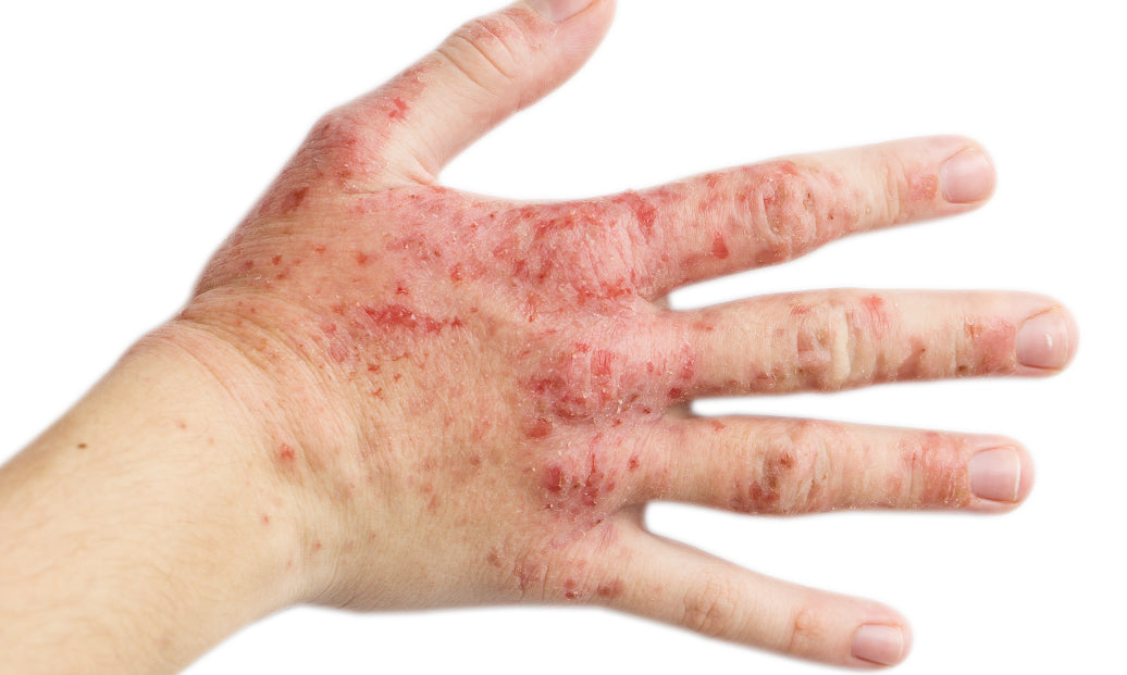 What’s The Main Cause Of Eczema?