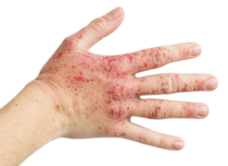 What’s The Main Cause Of Eczema?