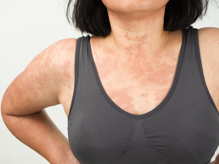 Can Anxiety Cause Rashes?