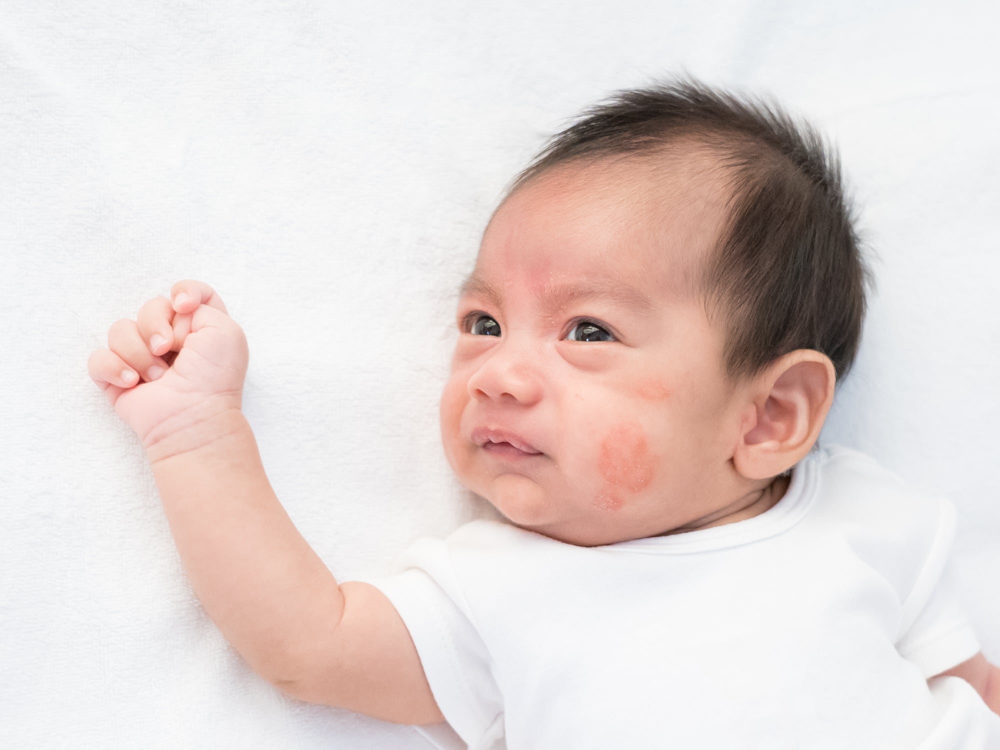 What Foods Trigger Eczema In Babies?