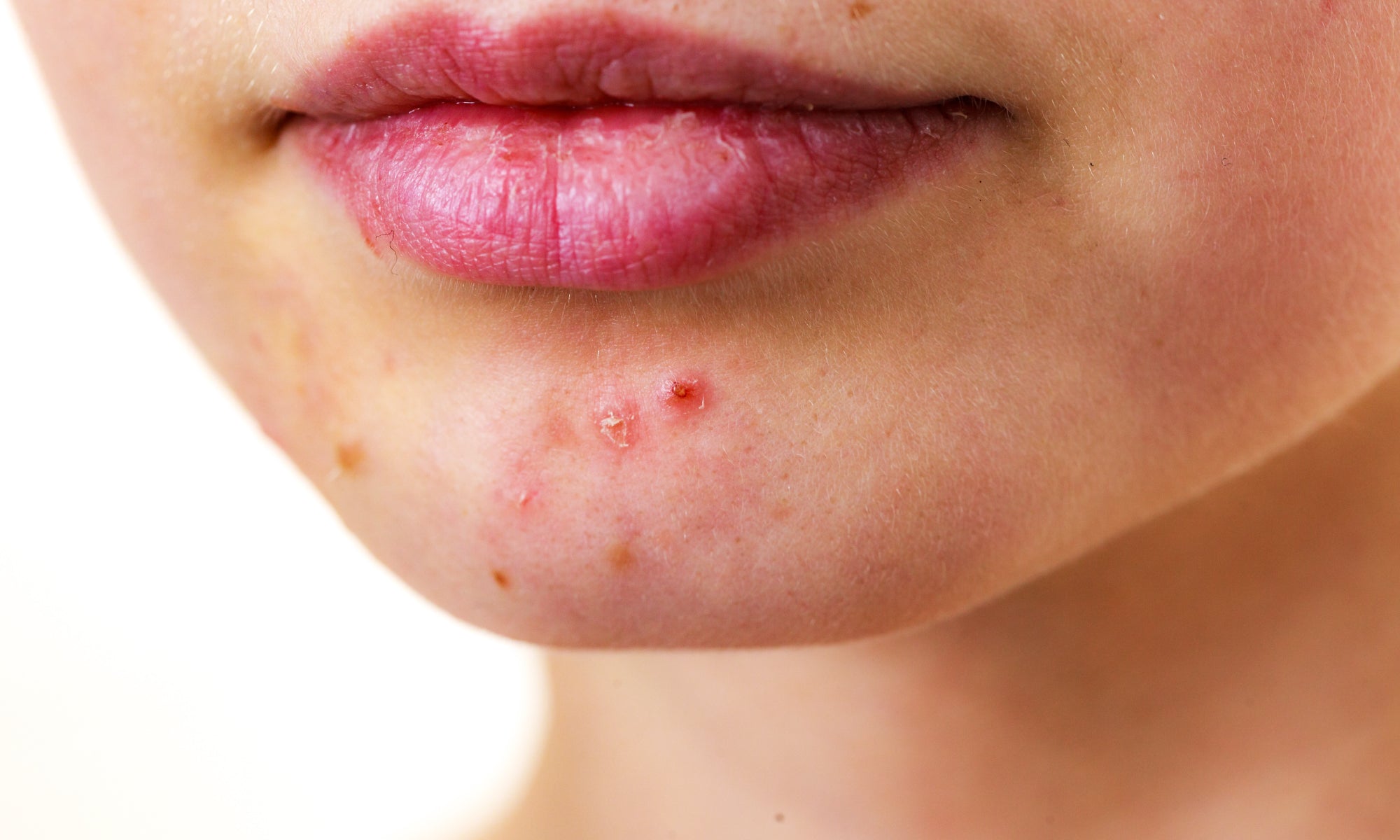 What Is It? Perioral Dermatitis Vs Acne