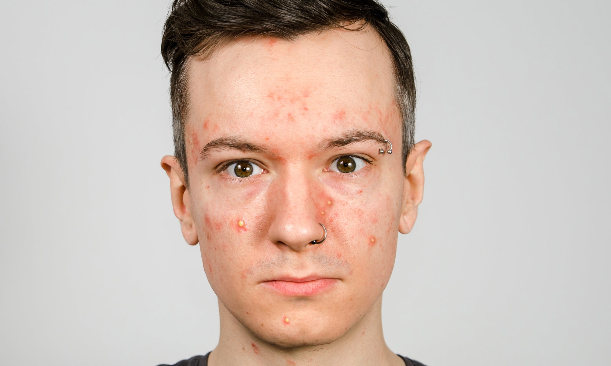 What Skin Infection Looks Like Acne?