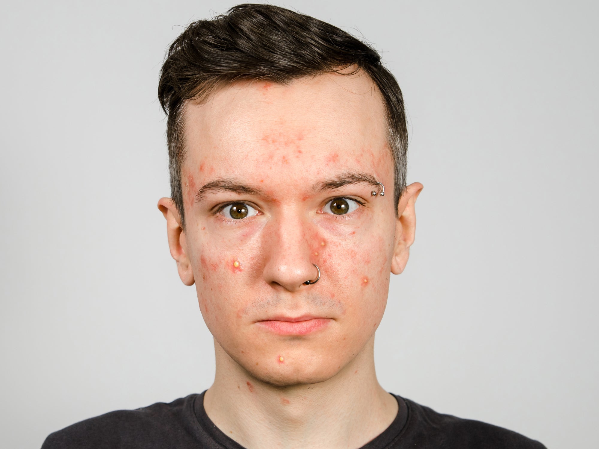 Staph Infection On Baby Face