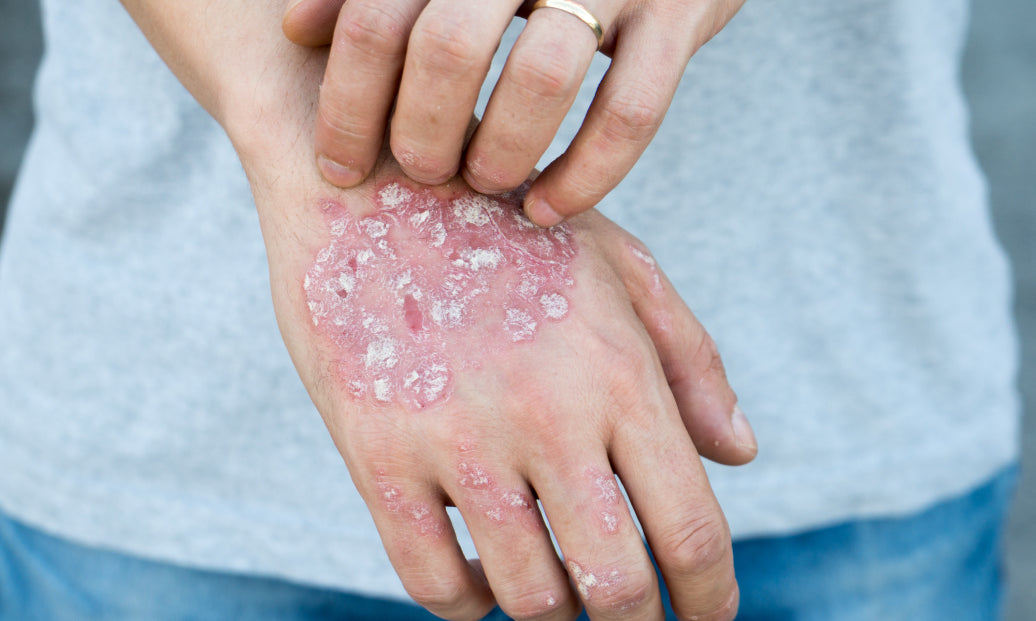 What Organs Can Be Affected By Psoriasis?