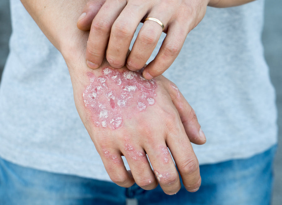 What Organs Can Be Affected By Psoriasis?