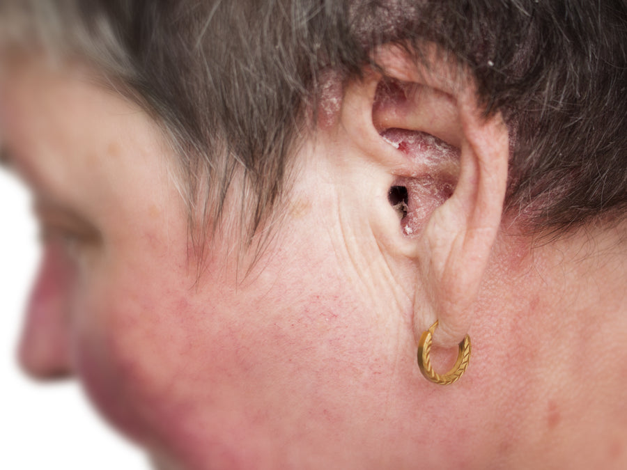 Can You Cure Aural Dermatitis/Ear Eczema?