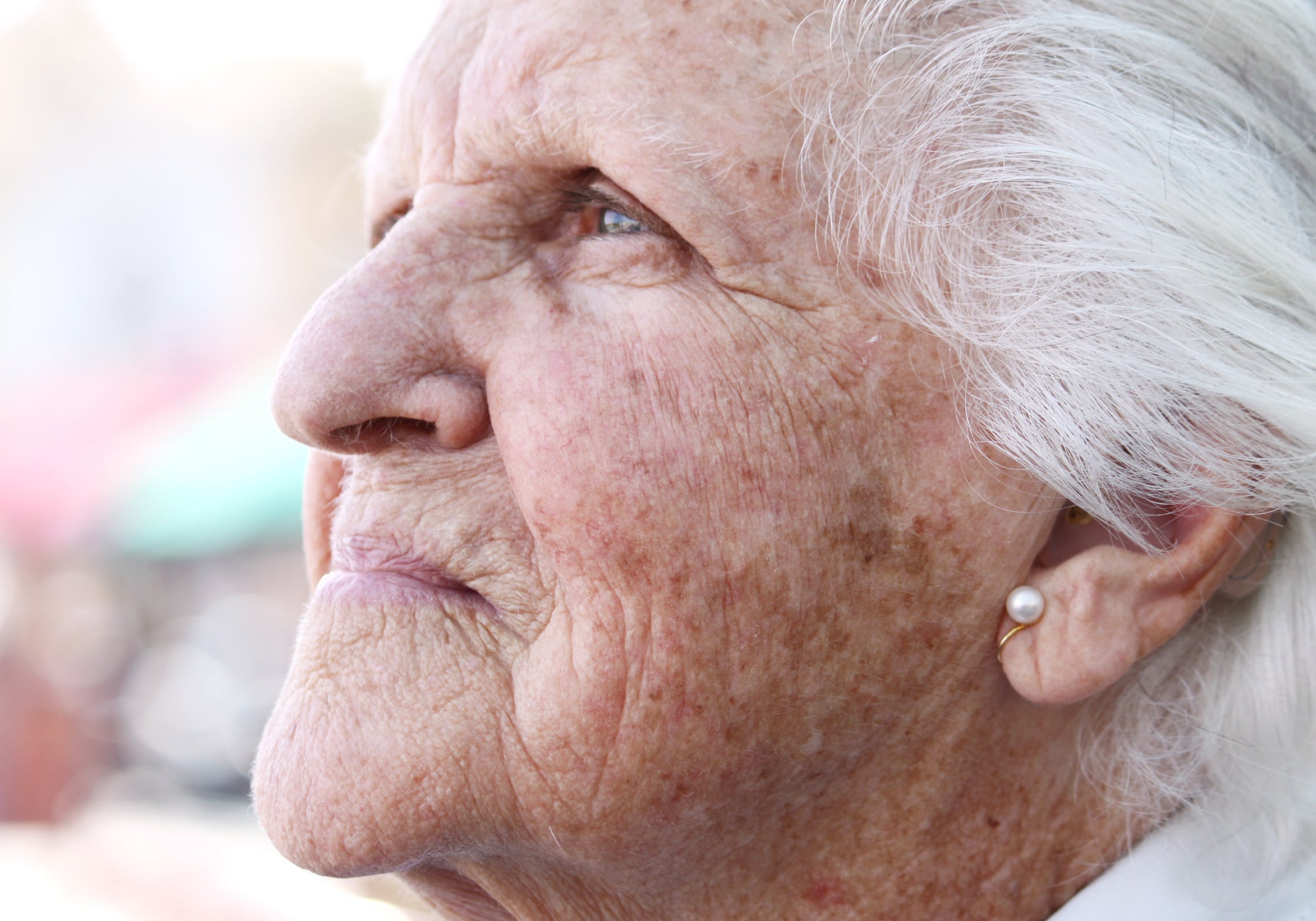 A person staring into the distance with signs of Actinic Keratosis on face.