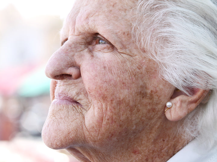 A person staring into the distance with signs of Actinic Keratosis on face.