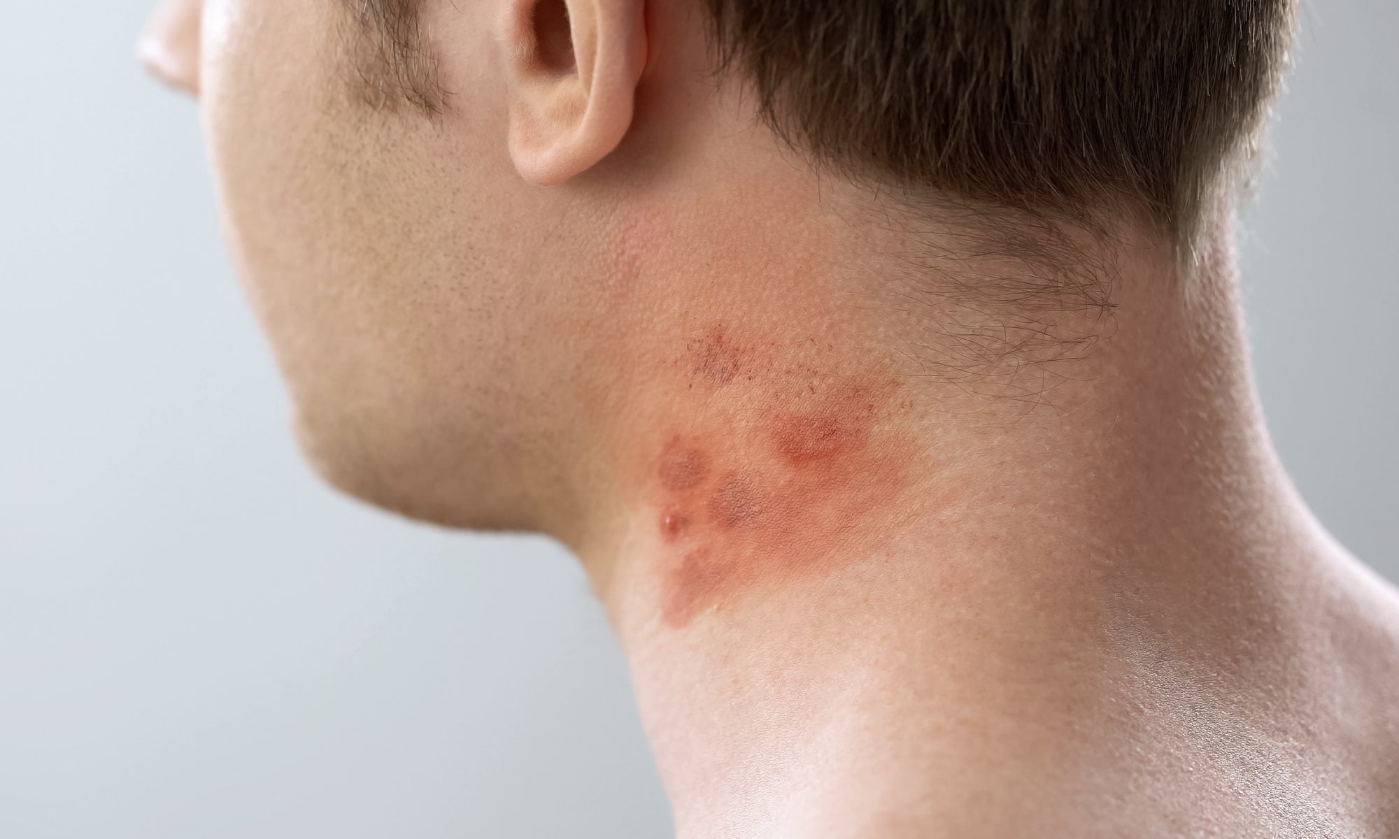 Can Contact Dermatitis Look Like Acne?