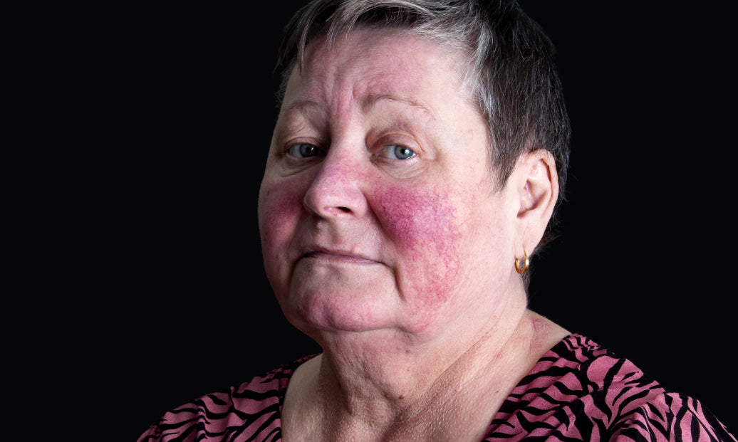 Example of Rosacea