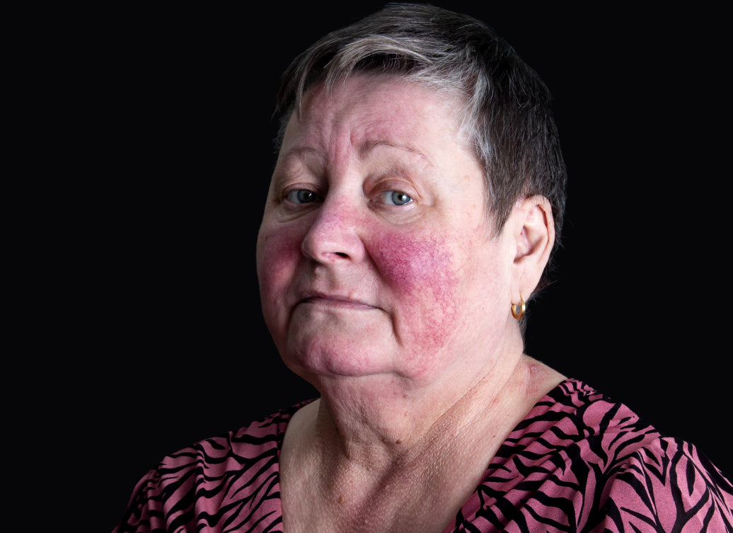 Example of Rosacea