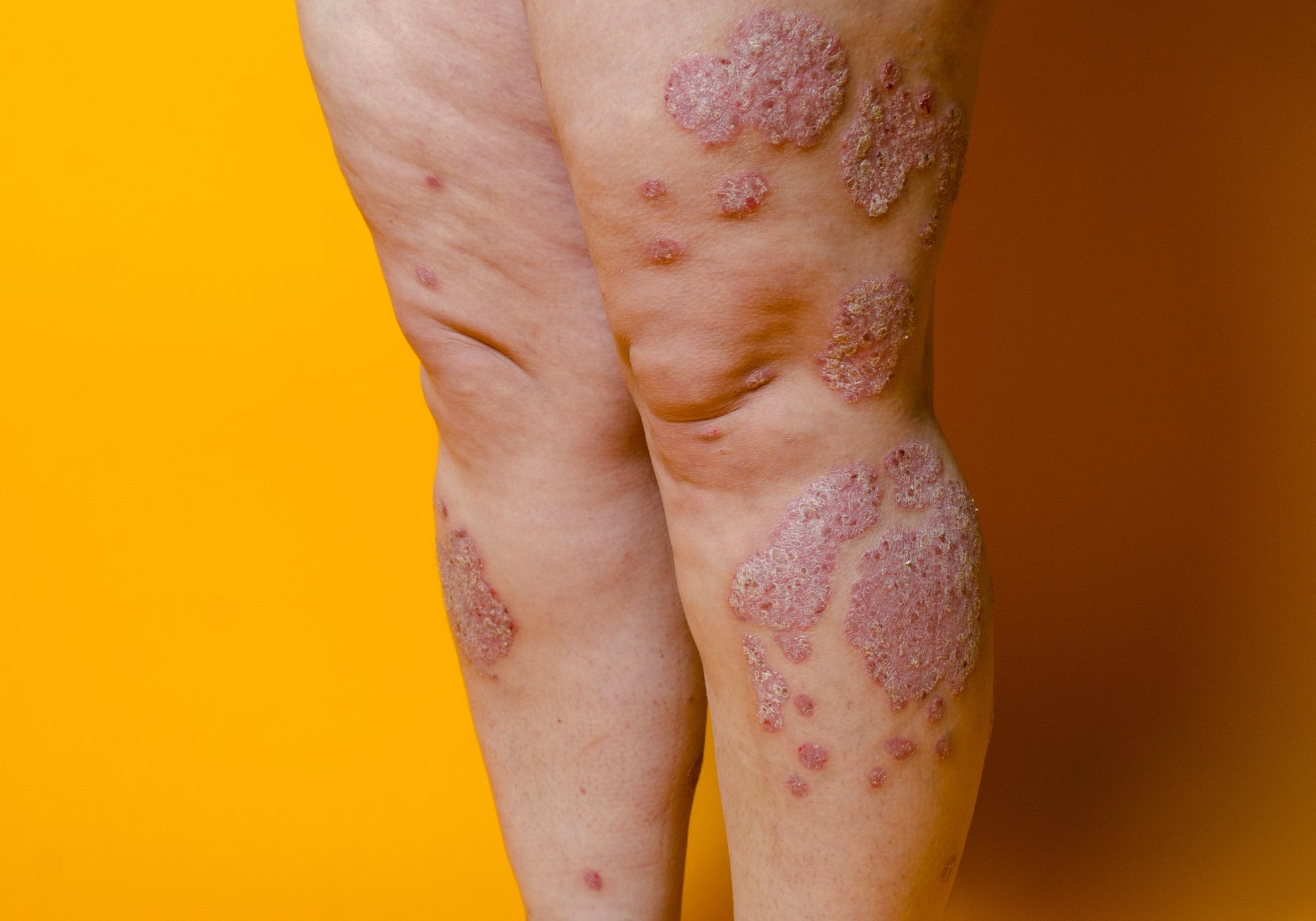 Can Psoriasis Be A Symptom Of Something Else?