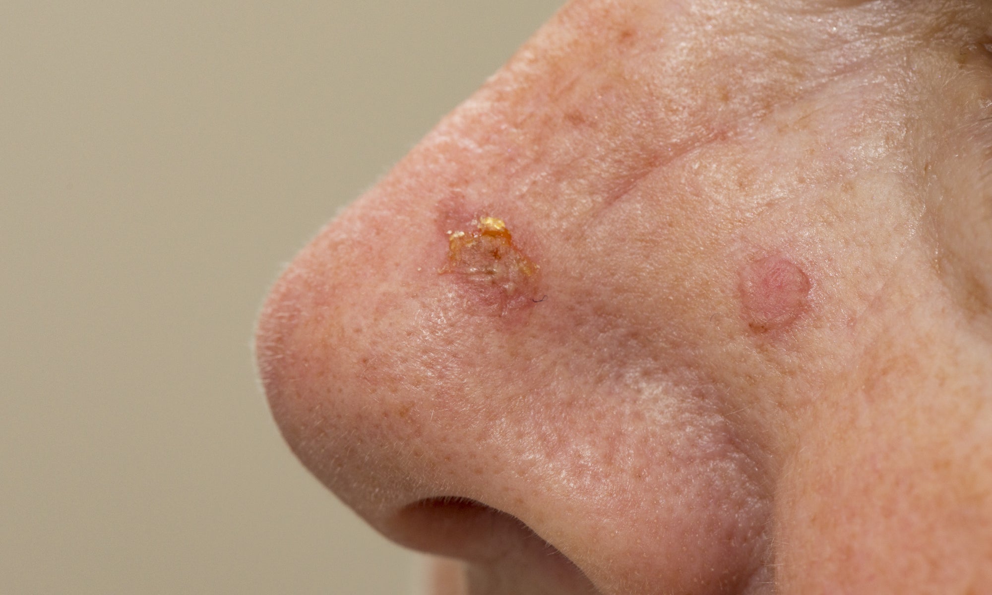 An example of Actinic Keratosis on the face