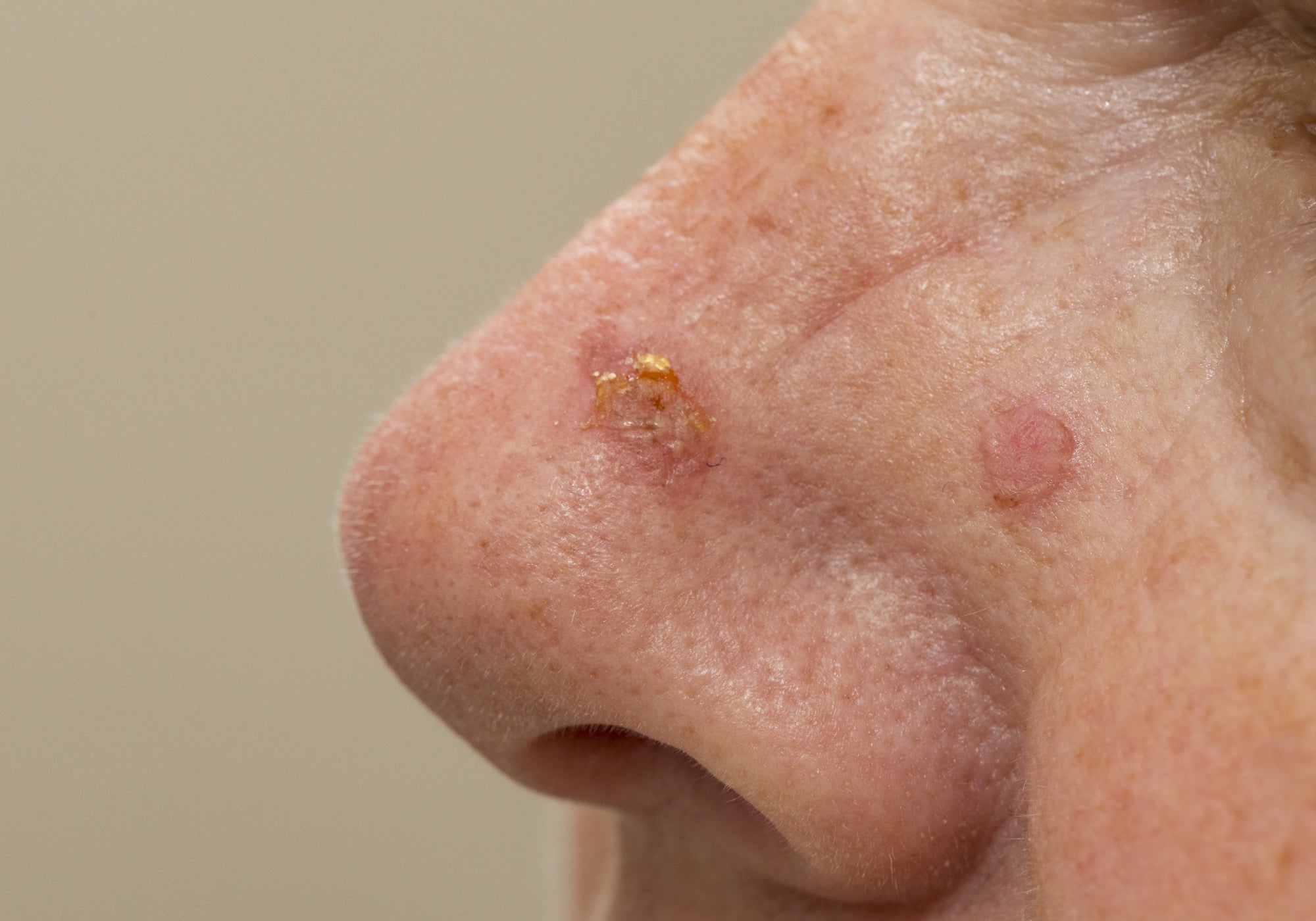 An example of Actinic Keratosis on the face