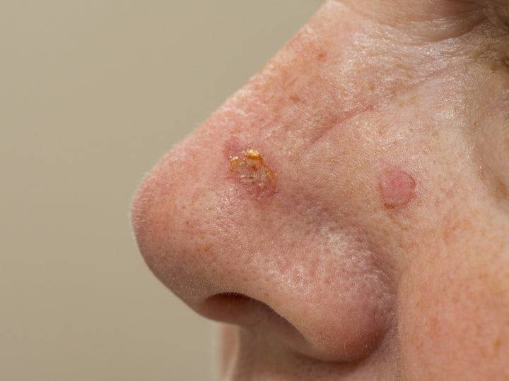 An example of Actinic Keratosis on the face
