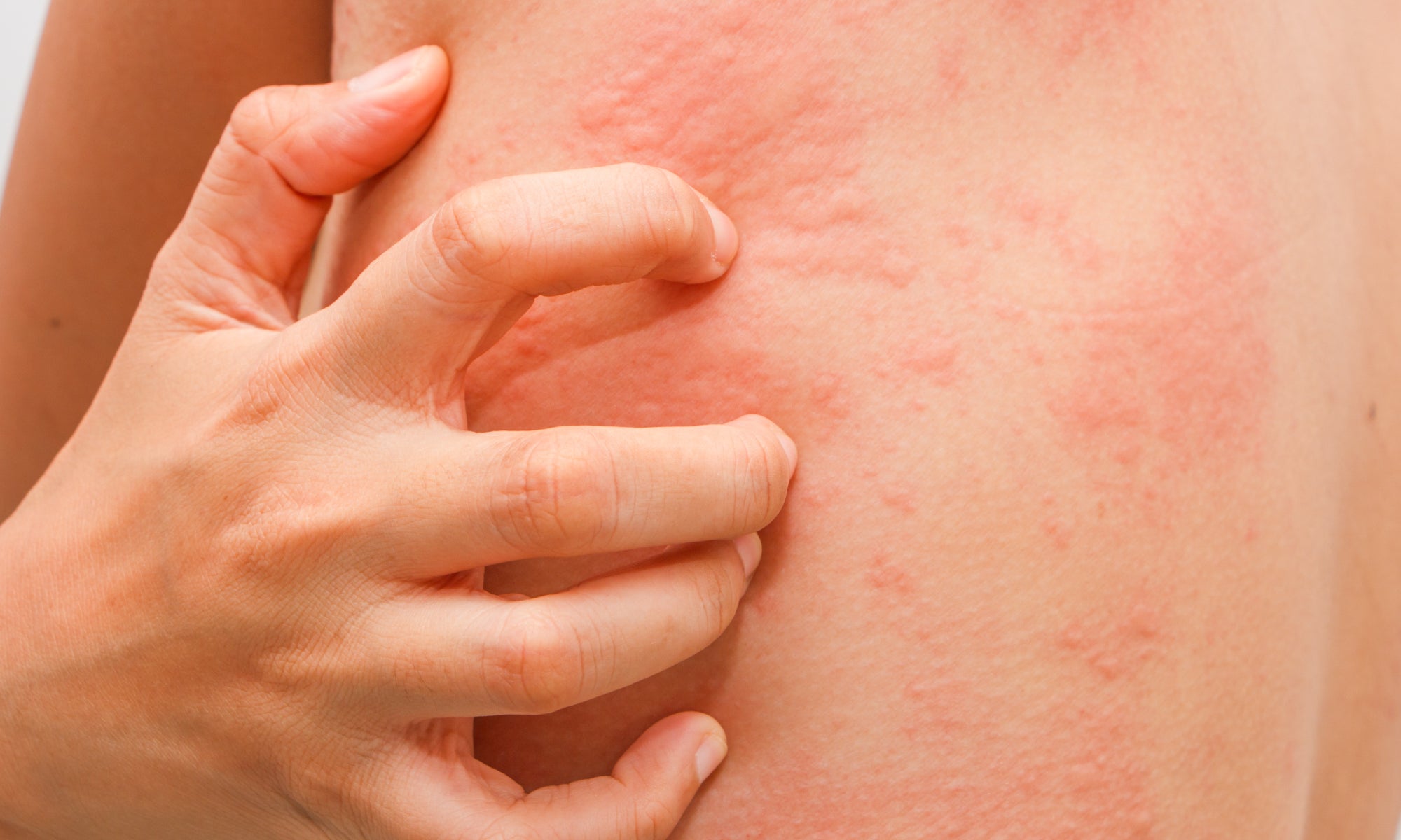 What Is Chemo Rash?