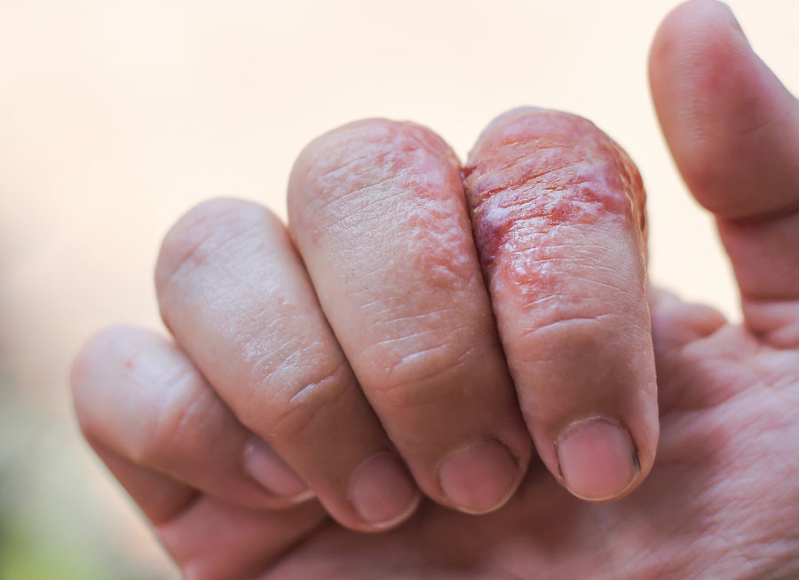 rash on fingers