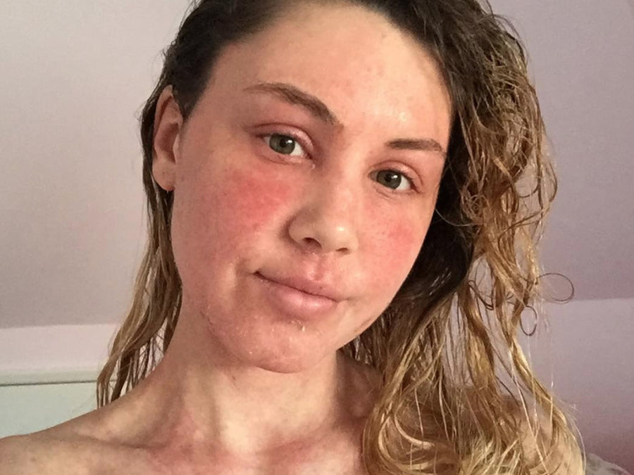 Does Diet Effect Red Skin Syndrome/Topical Steroid Withdrawl (TSW)?