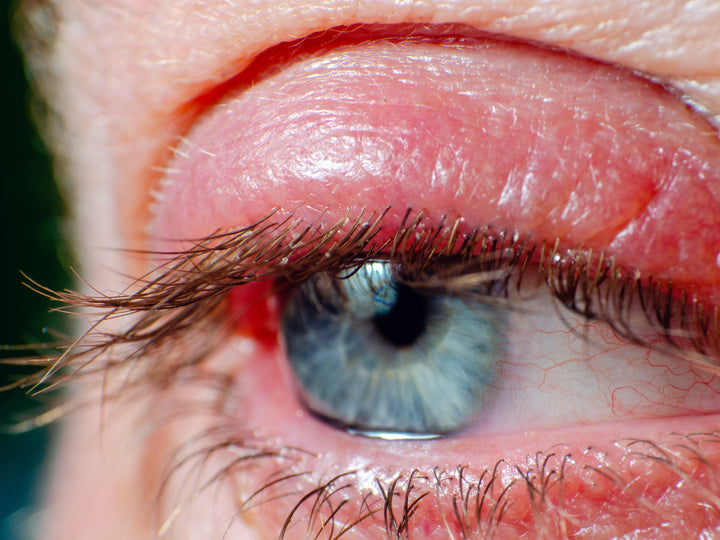An example of an eye with Blepharitis